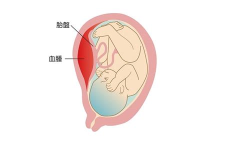 胎盤早期剝離 屬性